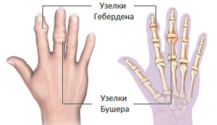 узелки Гебердена и Бушара