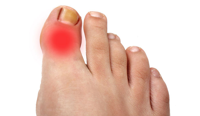 Воспаление сустава большого пальца ноги