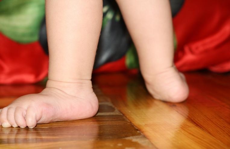 Врожденная вальгусная стопа