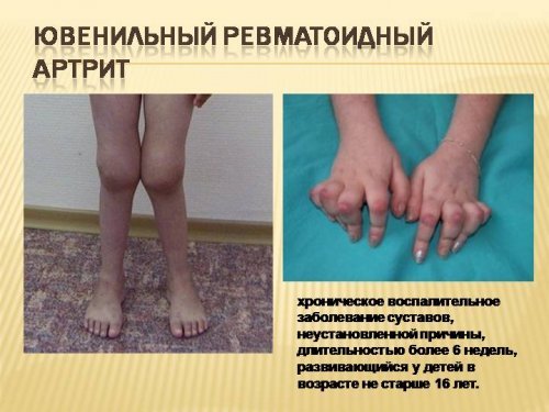 ювенильный ревматоидный артрит