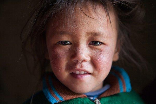 Аллергия у ребенка