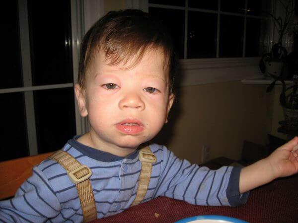 открытый артериальный проток у детей