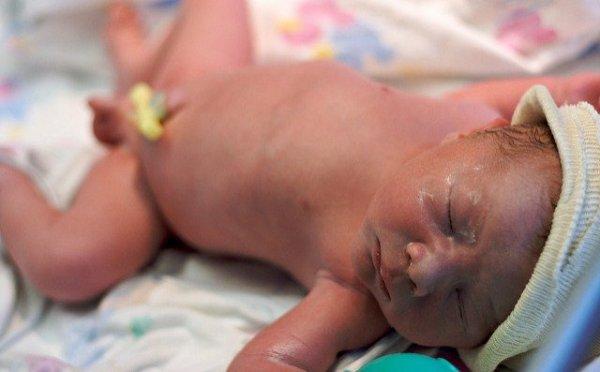 Диагностика омфалита