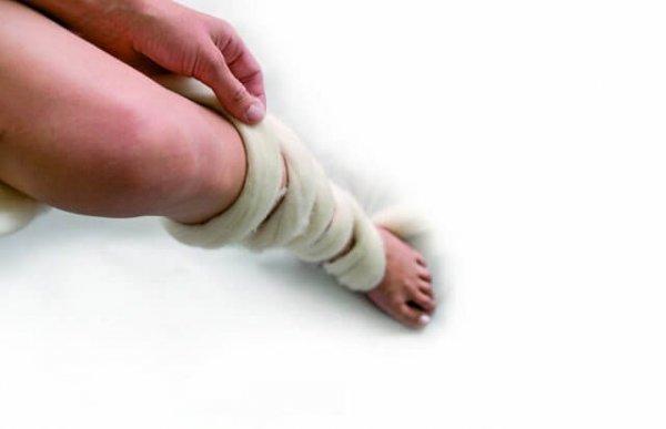 Варикоз при беременности