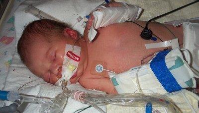 Синдром аспирации мекония