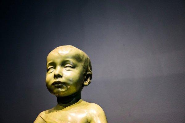 Причины асимметрии головы