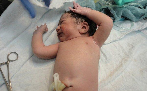 Омфалит у новорожденных