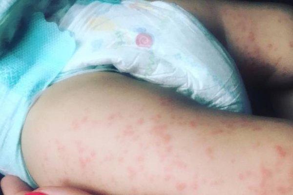 Симптомы диатеза