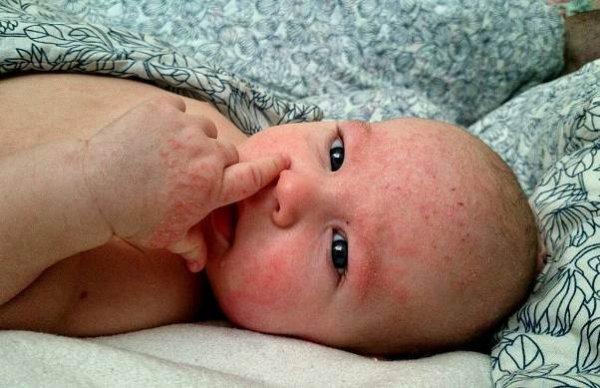 Диатез у грудничка