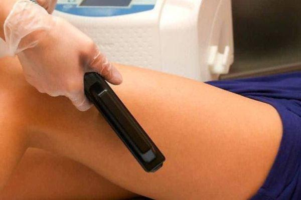 Лазерная эпиляция