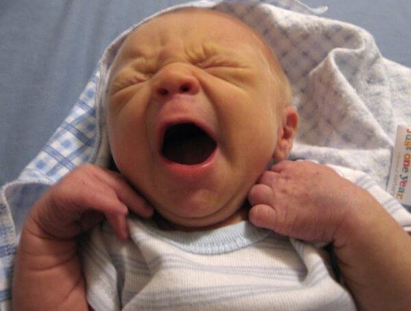 синдром грефе у новорожденных