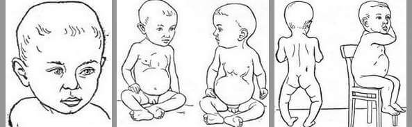 Как лечить рахит у ребенка