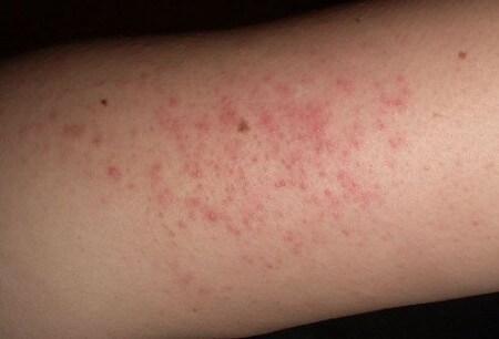 прыщи на руках после родов