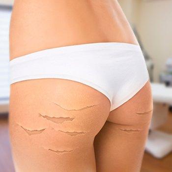 избавление от растяжек