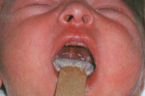 Осложнения при молочнице