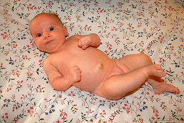 Симптомы пупочной грыжи