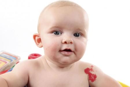 Родимое пятно у новорожденного