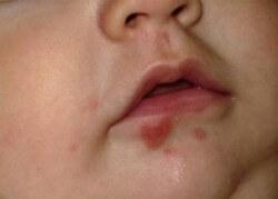 герпес у новорожденных