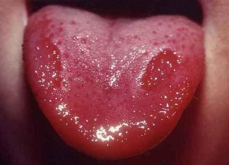 Красные пятна на языке у грудничка
