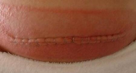 сколько заживают швы после родов